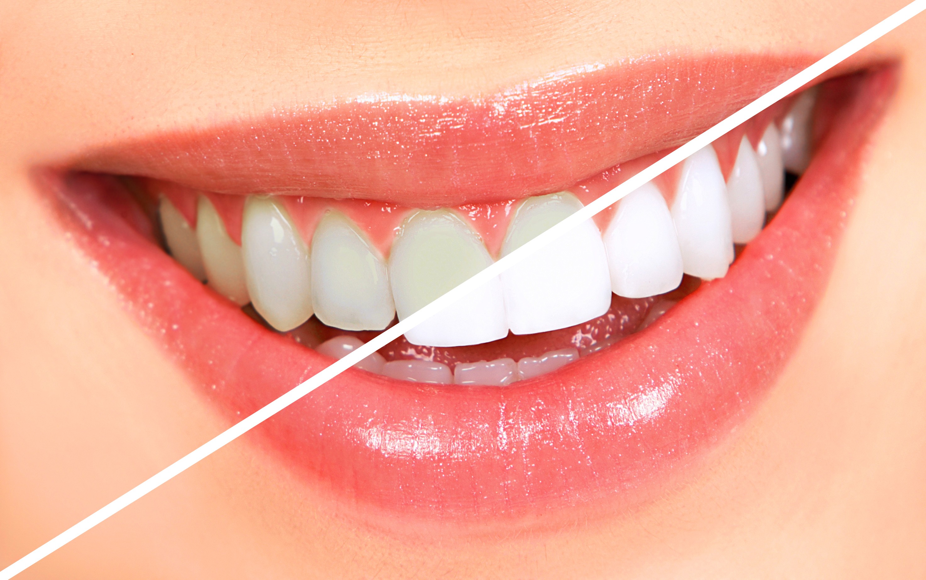 Teeth Whitening - Lantern Dental
